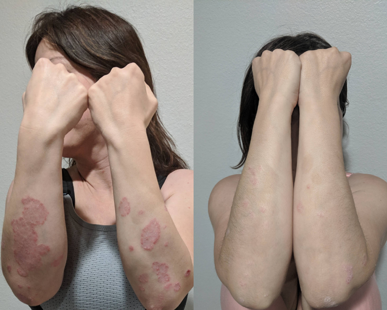 CASE STUDY: Psoriasis and Herbal Medicine - Amethyst Holistic Skin Solutions