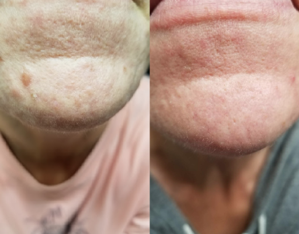 nodular acne vs cystic acne