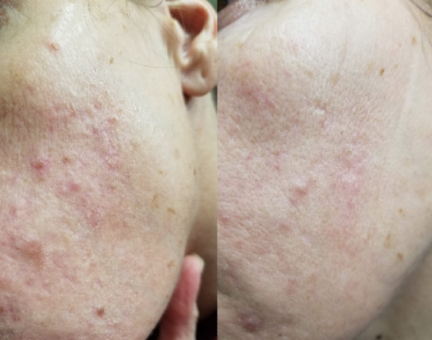 nodular acne vs cystic acne