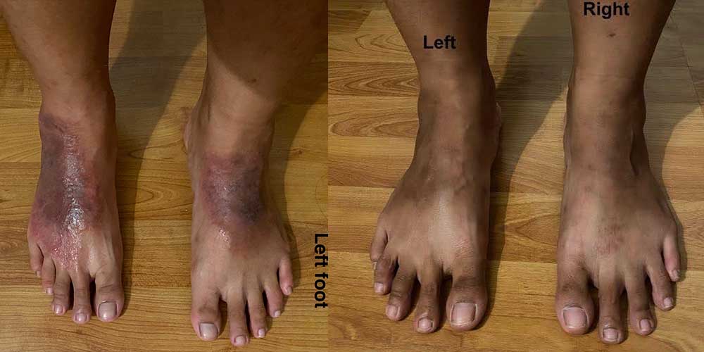 Athletes foot (Tinea pedis) Consult us for all fungal problems of the feet.