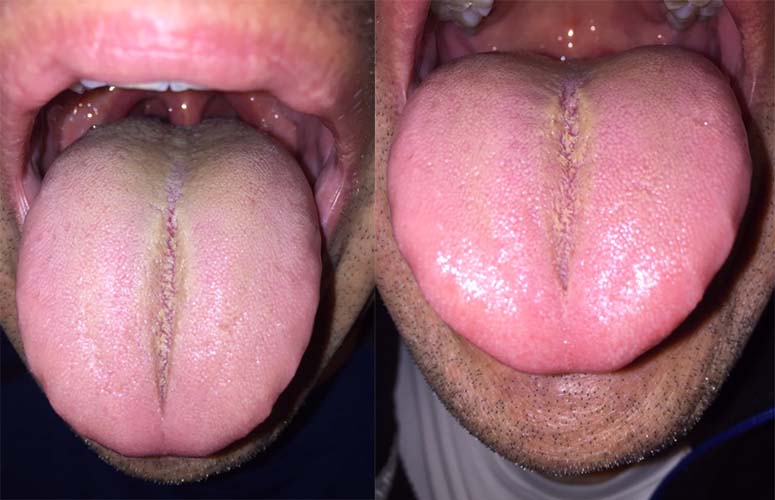 tongue diagnosis