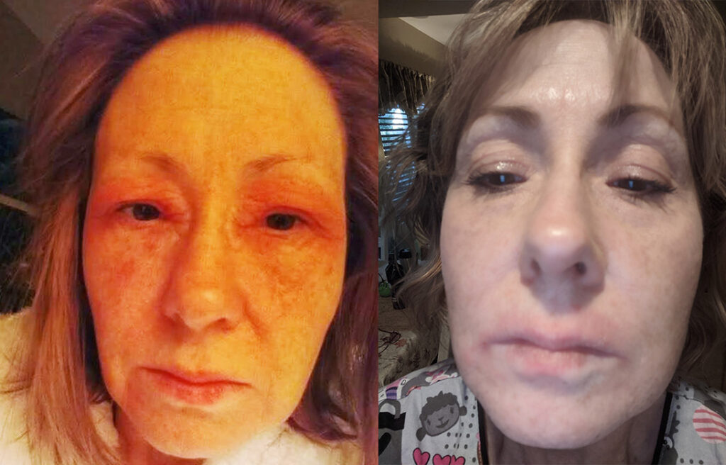 facial eczema before and after