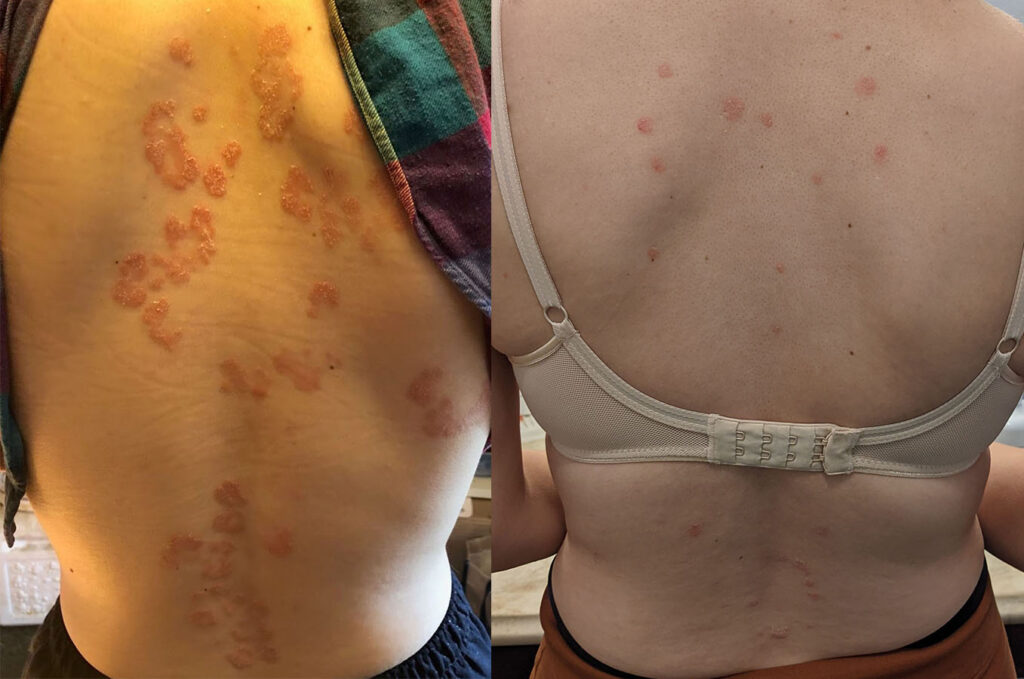 psoriasis before and after