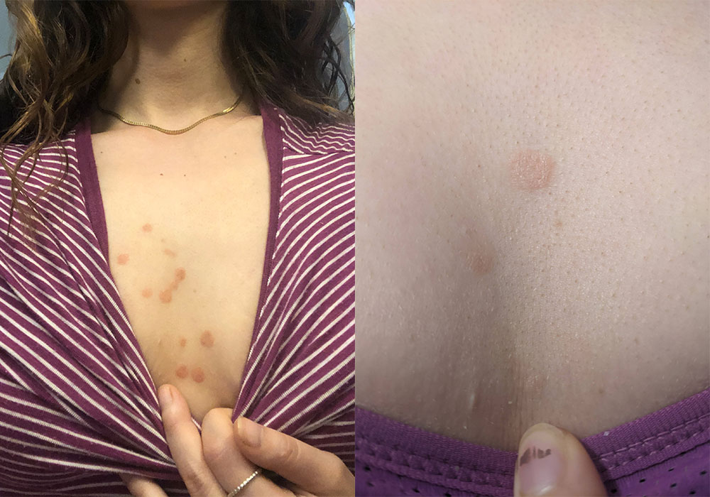 before and after psoriasis photo