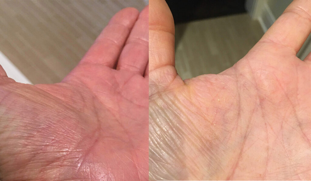 eczema treatment