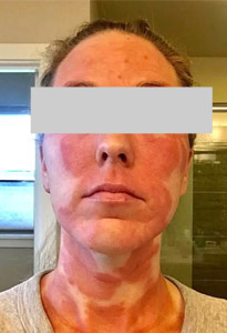 woman with TSW skin condition