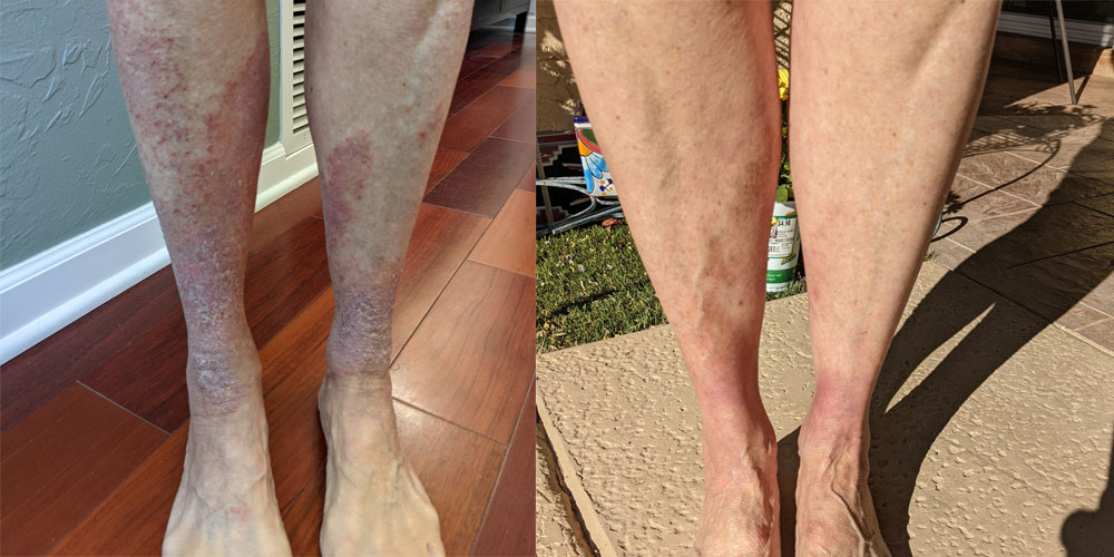 eczema legs