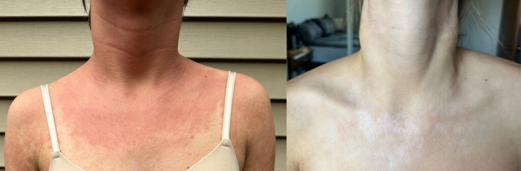 eczema on chest before and after