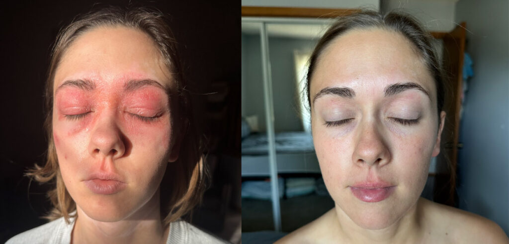 eczema on eyelids before and after