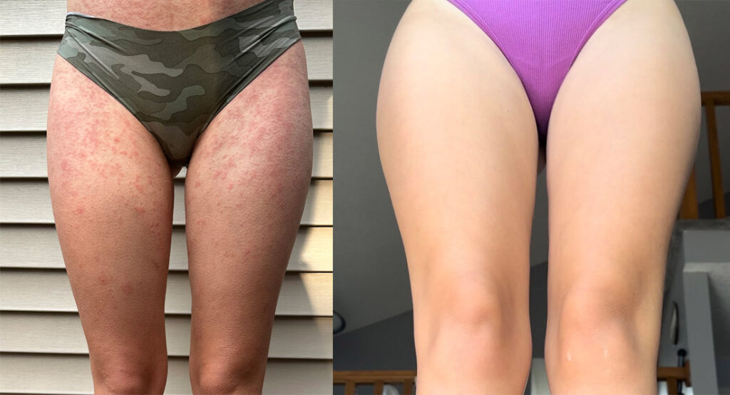 eczema on thighs before and after