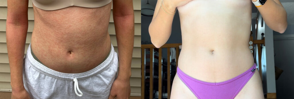 eczema on torso before and after